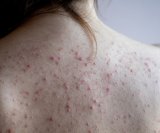 Leđa su jedno od najčešćih mjesta za pojavu akni jer imaju mnogo lojnih žlijezda i deblju kožu, što povećava rizik od začepljenih pora