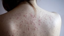 Leđa su jedno od najčešćih mjesta za pojavu akni jer imaju mnogo lojnih žlijezda i deblju kožu, što povećava rizik od začepljenih pora