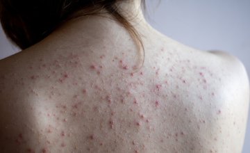 Leđa su jedno od najčešćih mjesta za pojavu akni jer imaju mnogo lojnih žlijezda i deblju kožu, što povećava rizik od začepljenih pora
