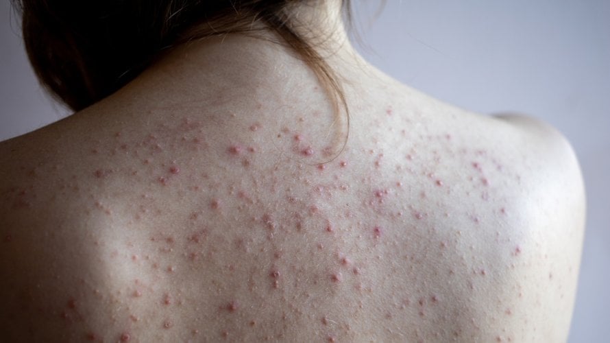 Leđa su jedno od najčešćih mjesta za pojavu akni jer imaju mnogo lojnih žlijezda i deblju kožu, što povećava rizik od začepljenih pora