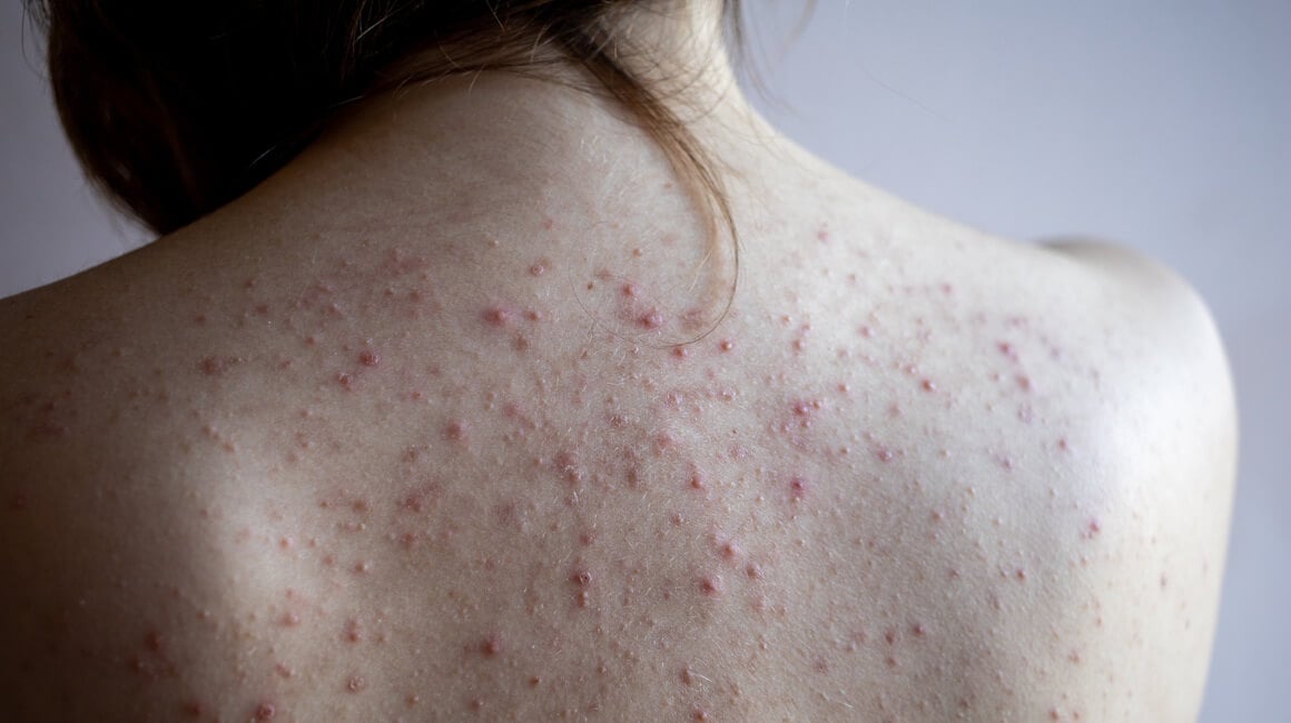 Leđa su jedno od najčešćih mjesta za pojavu akni jer imaju mnogo lojnih žlijezda i deblju kožu, što povećava rizik od začepljenih pora