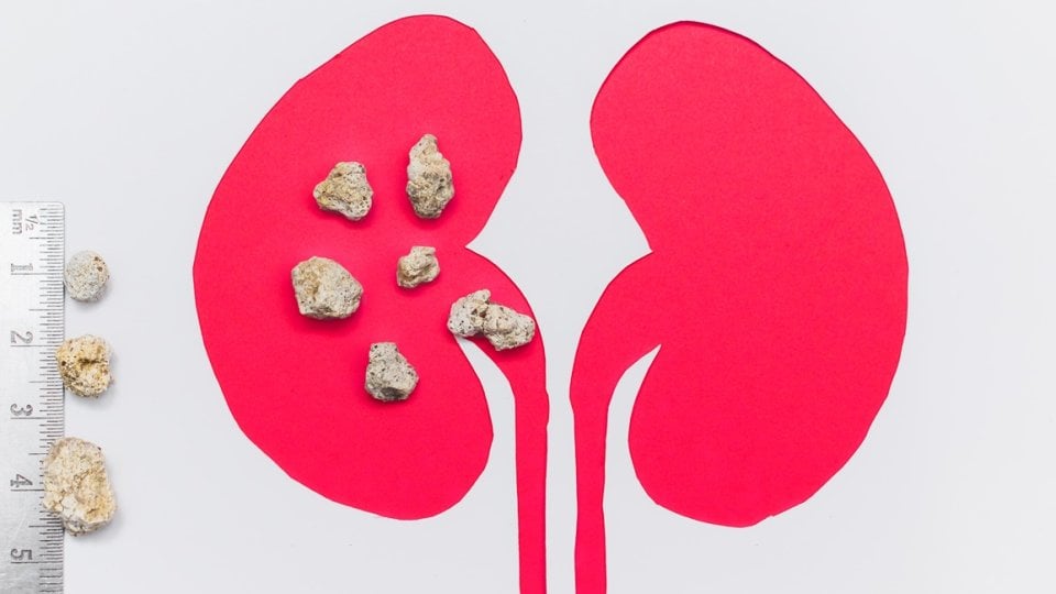 Magnezij i bubrežni kamenci