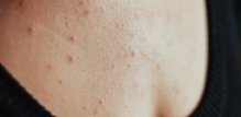 Na prsima se najčešće javlja klasični oblik akni (acne vulgaris), koji nastaje kada se pore začepe masnoćom, mrtvim stanicama kože i bakterijama