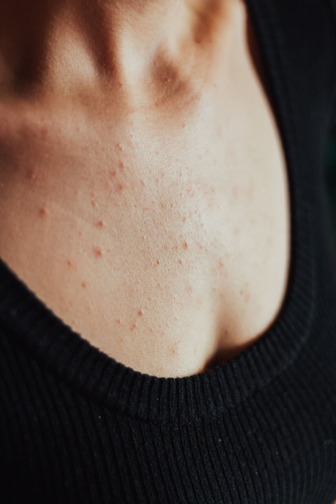Na prsima se najčešće javlja klasični oblik akni (acne vulgaris), koji nastaje kada se pore začepe masnoćom, mrtvim stanicama kože i bakterijama