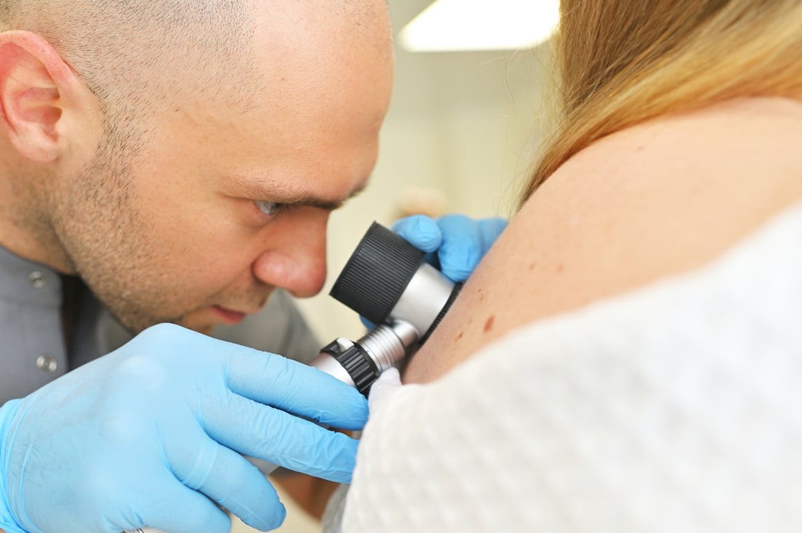 Najčešće se melanom otkriva pregledom kod dermatologa, no dostupnost stručnjaka ponekad može odgoditi dijagnozu