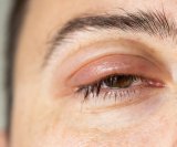 Otečeni kapci i bubrezi