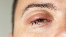 Otečeni kapci i bubrezi