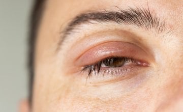 Otečeni kapci i bubrezi