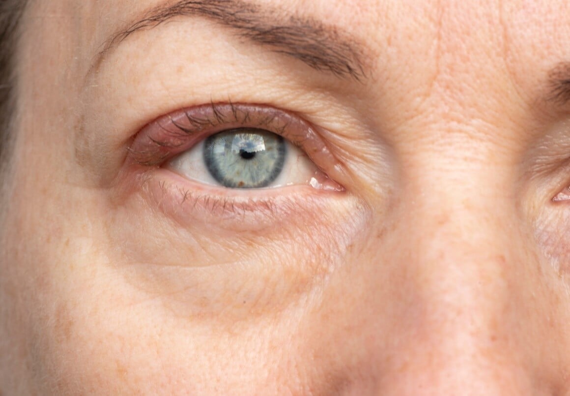 Otečeni kapci i bubrezi - prvi znak problema s bubrezima