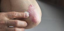 Plak psorijaza - liječenje