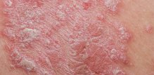 Plak psorijaza tip