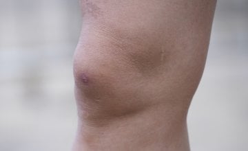 Prirodni lijek za vodu u koljenu