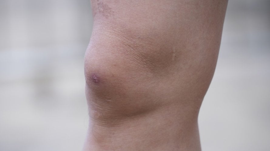 Prirodni lijek za vodu u koljenu