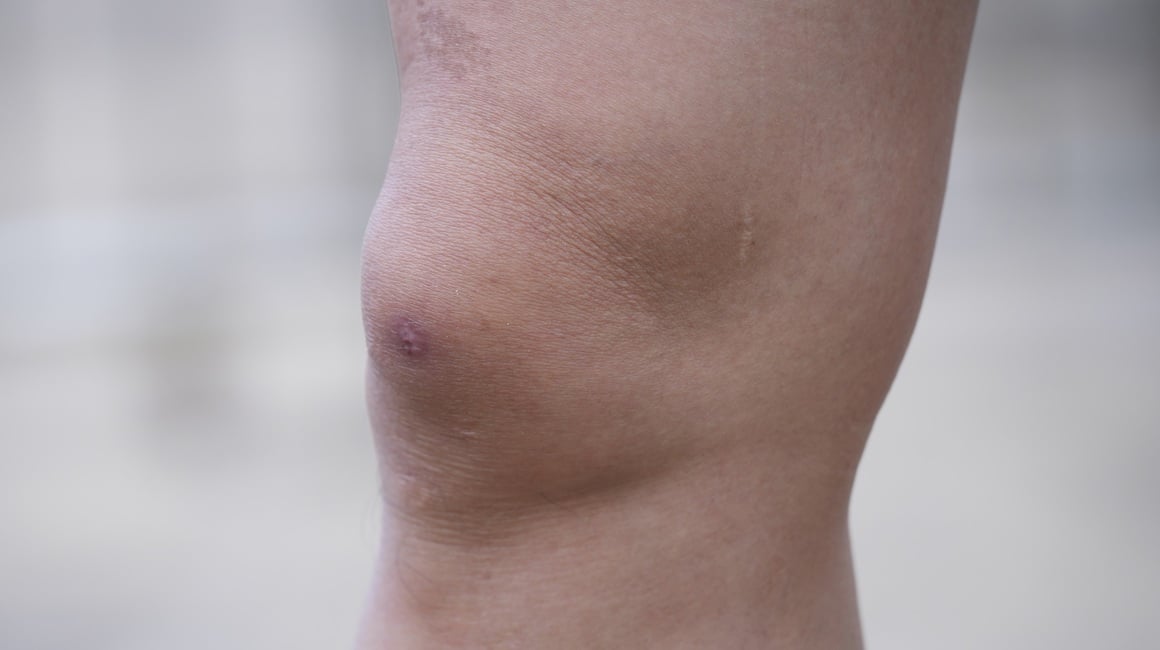 Prirodni lijek za vodu u koljenu