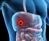 Rak jetre jedan je od vodećih uzroka smrtnosti od raka u svijetu