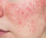 Rozacea je kronična kožna bolest koja uzrokuje crvenilo, upalu i osip, najčešće na području nosa i obraza