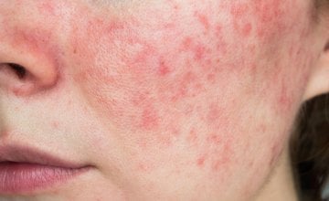 Rozacea je kronična kožna bolest koja uzrokuje crvenilo, upalu i osip, najčešće na području nosa i obraza