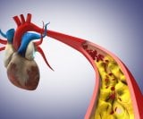 Snažno snižavanje povišenog kolesterola moglo bi smanjiti rizik od srčanog ili moždanog udara za otprilike trećinu kod osoba koje već imaju začepljene arterije