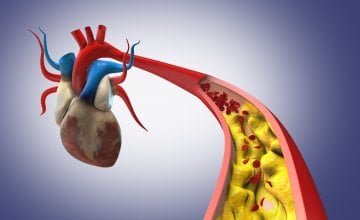 Snažno snižavanje povišenog kolesterola moglo bi smanjiti rizik od srčanog ili moždanog udara za otprilike trećinu kod osoba koje već imaju začepljene arterije