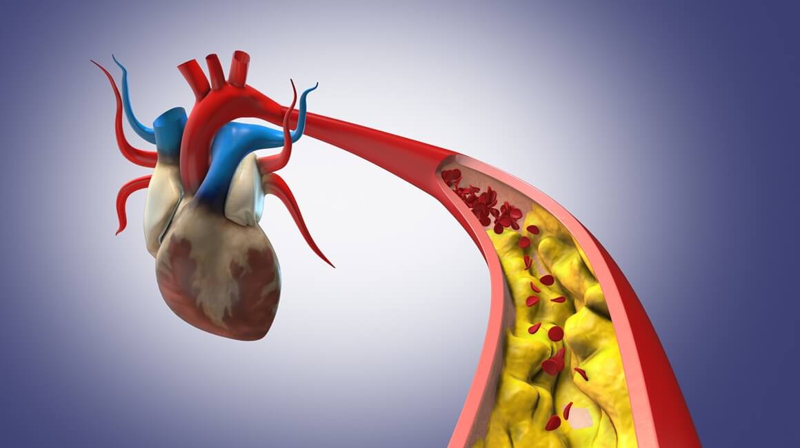 Snažno snižavanje povišenog kolesterola moglo bi smanjiti rizik od srčanog ili moždanog udara za otprilike trećinu kod osoba koje već imaju začepljene arterije