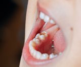 Uklanjanje fluorida iz javnih vodovodnih sustava moglo bi rezultirati većim brojem karijesa kod djece