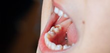 Uklanjanje fluorida iz javnih vodovodnih sustava moglo bi rezultirati većim brojem karijesa kod djece