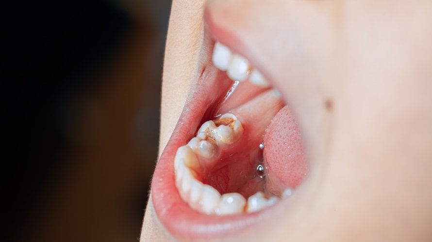 Uklanjanje fluorida iz javnih vodovodnih sustava moglo bi rezultirati većim brojem karijesa kod djece