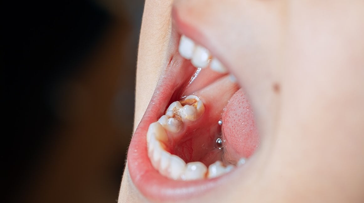 Uklanjanje fluorida iz javnih vodovodnih sustava moglo bi rezultirati većim brojem karijesa kod djece