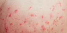 acne mechanica nastaju isključivo zbog fizičkih čimbenika - ponajprije trenja