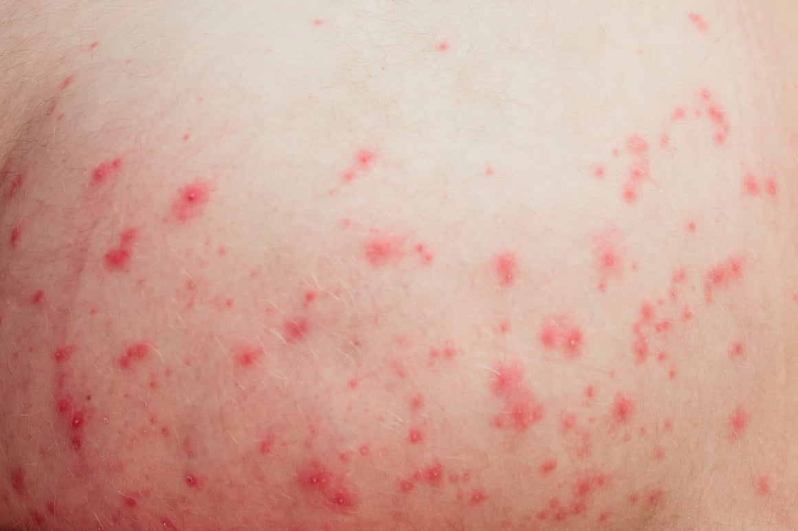 acne mechanica nastaju isključivo zbog fizičkih čimbenika - ponajprije trenja