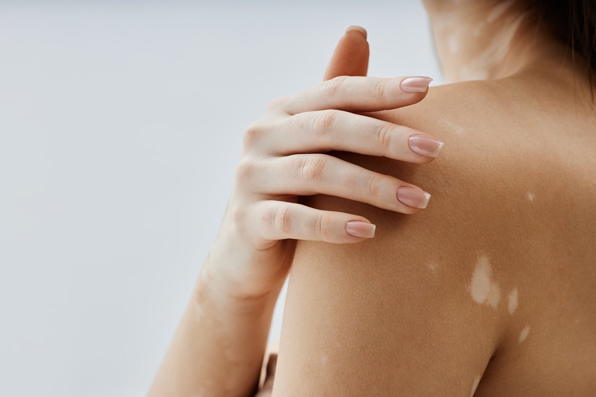 bijele mrlje od sunca