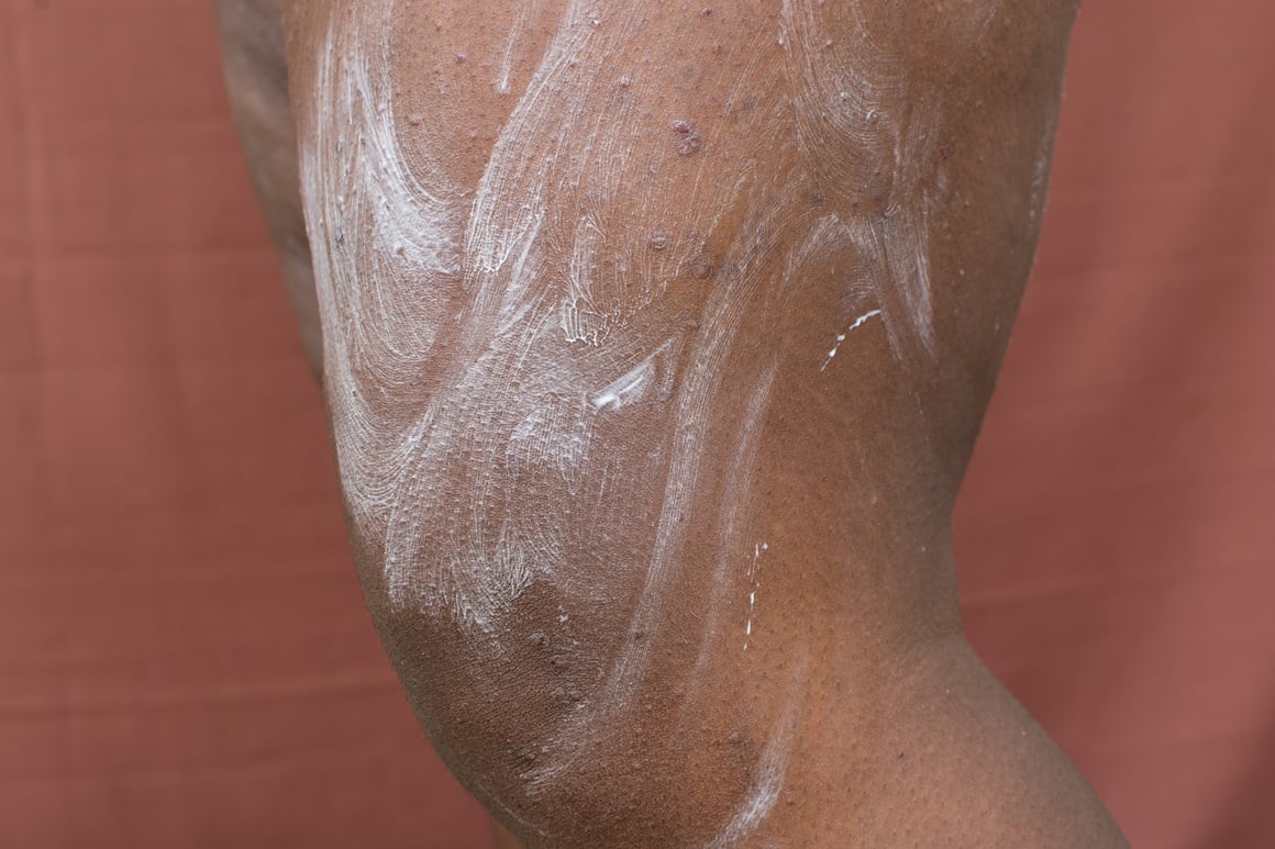 keto osip - liječenje