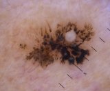 umjetna inteligencija bi uskoro mogla imati važniju ulogu u otkrivanju melanoma