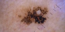 umjetna inteligencija bi uskoro mogla imati važniju ulogu u otkrivanju melanoma
