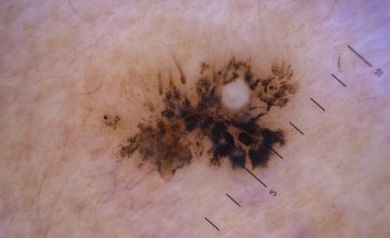 umjetna inteligencija bi uskoro mogla imati važniju ulogu u otkrivanju melanoma