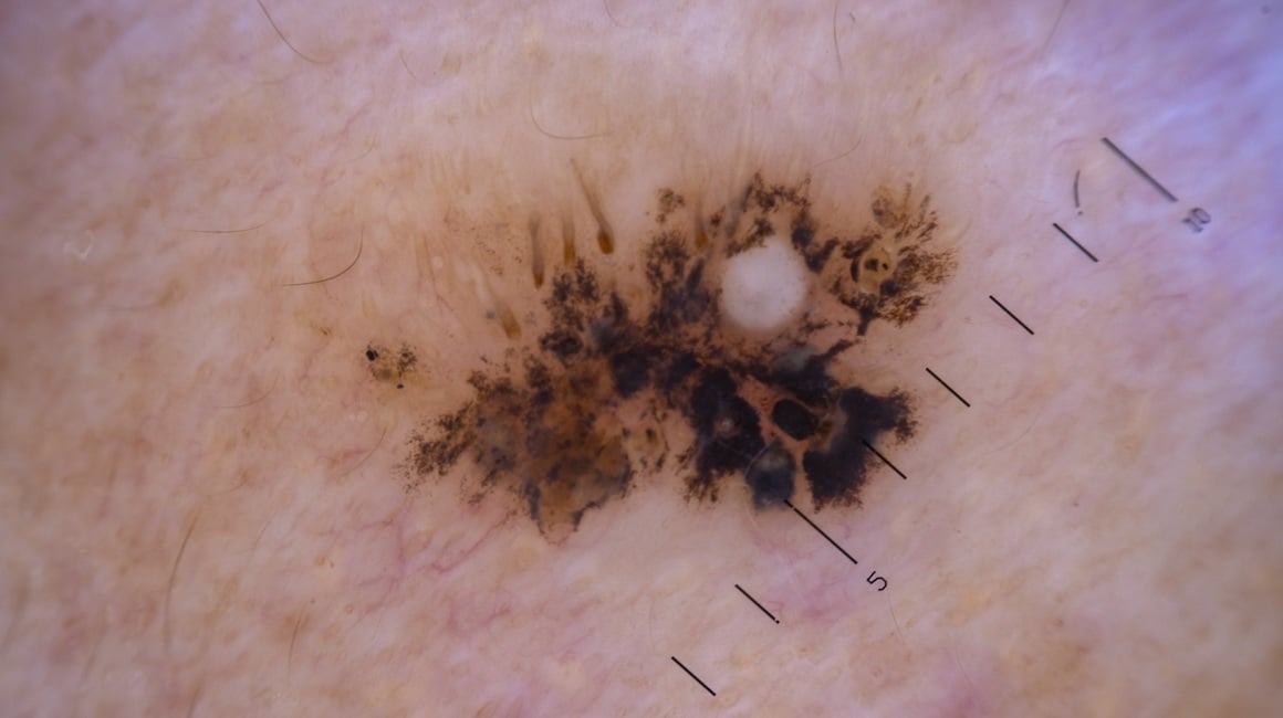 umjetna inteligencija bi uskoro mogla imati važniju ulogu u otkrivanju melanoma