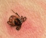Ako nakon boravka u prirodi osjećate ovo, nemojte ignorirati moguće znakove Lymeove bolesti