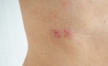Herpes zoster bolna je virusna infekcija koja uzrokuje osip i mjehuriće na koži