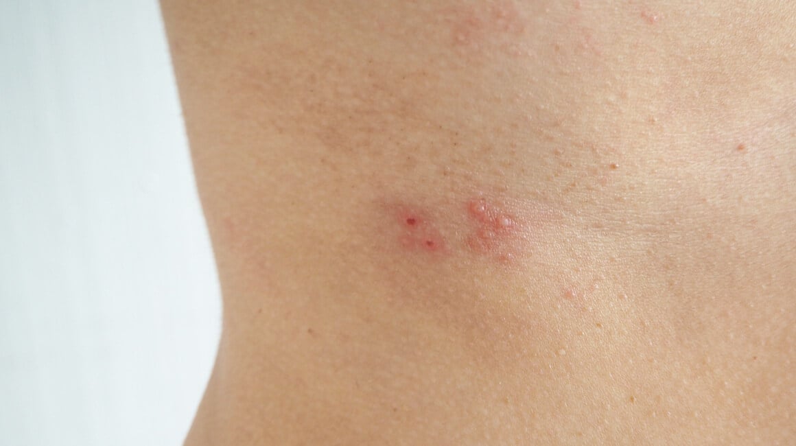 Herpes zoster bolna je virusna infekcija koja uzrokuje osip i mjehuriće na koži