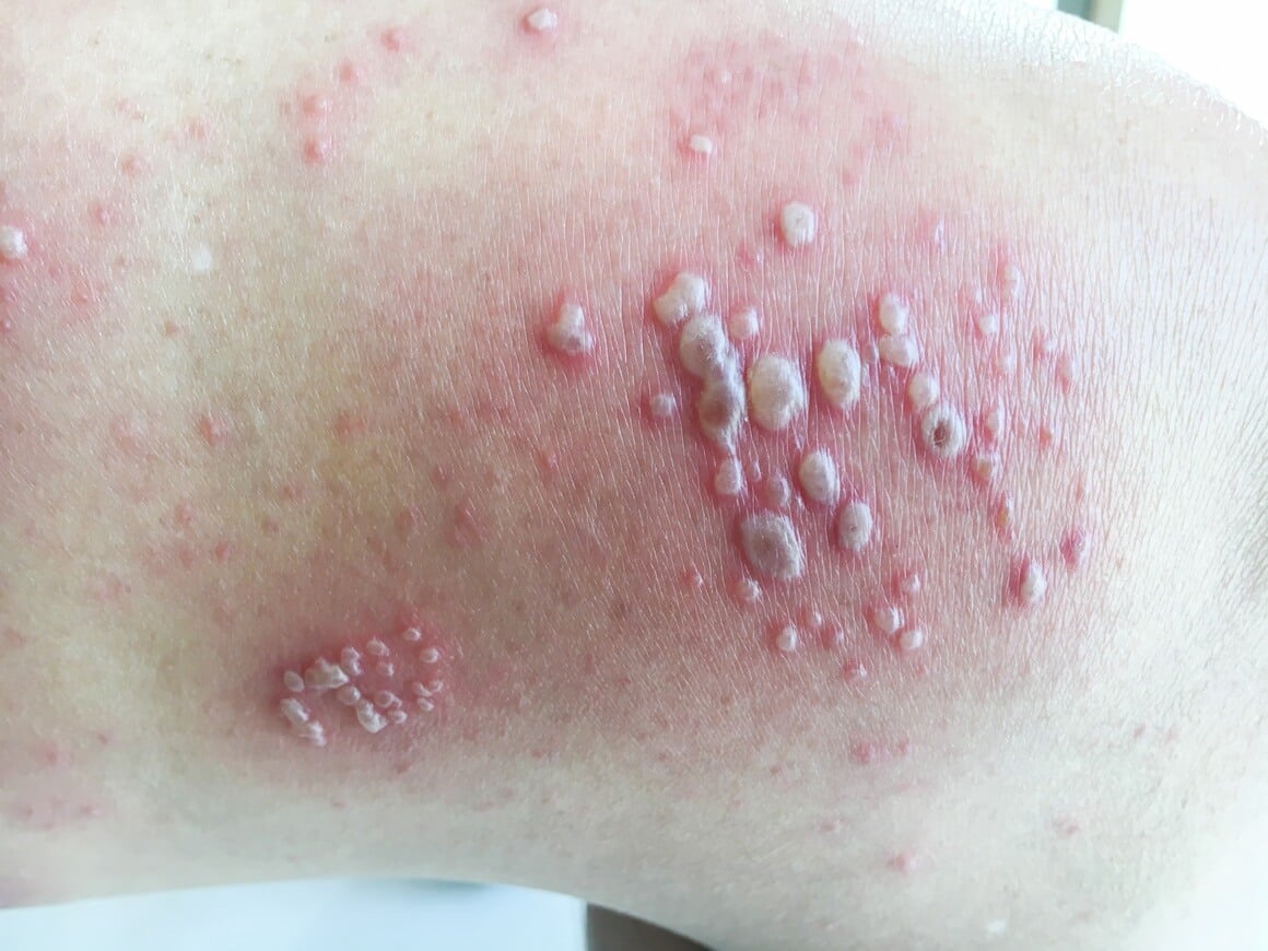 Herpes zoster uzrokuje varicella-zoster virus, isti onaj koji izaziva vodene kozice