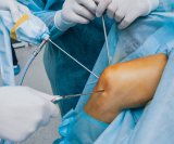 Istraživanje objavljeno u časopisu The New England Journal of Medicine dovodi u pitanje učinkovitost djelomičnog uklanjanja meniskusa