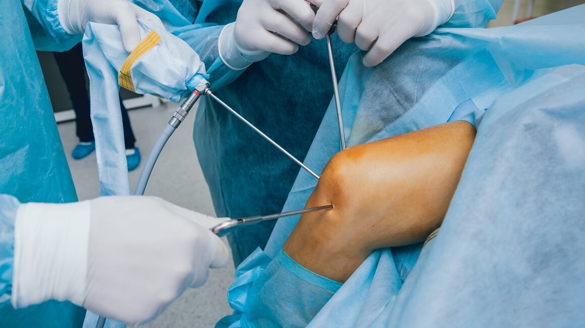 Istraživanje objavljeno u časopisu The New England Journal of Medicine dovodi u pitanje učinkovitost djelomičnog uklanjanja meniskusa