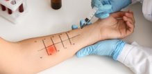 Kako se radi alergo test
