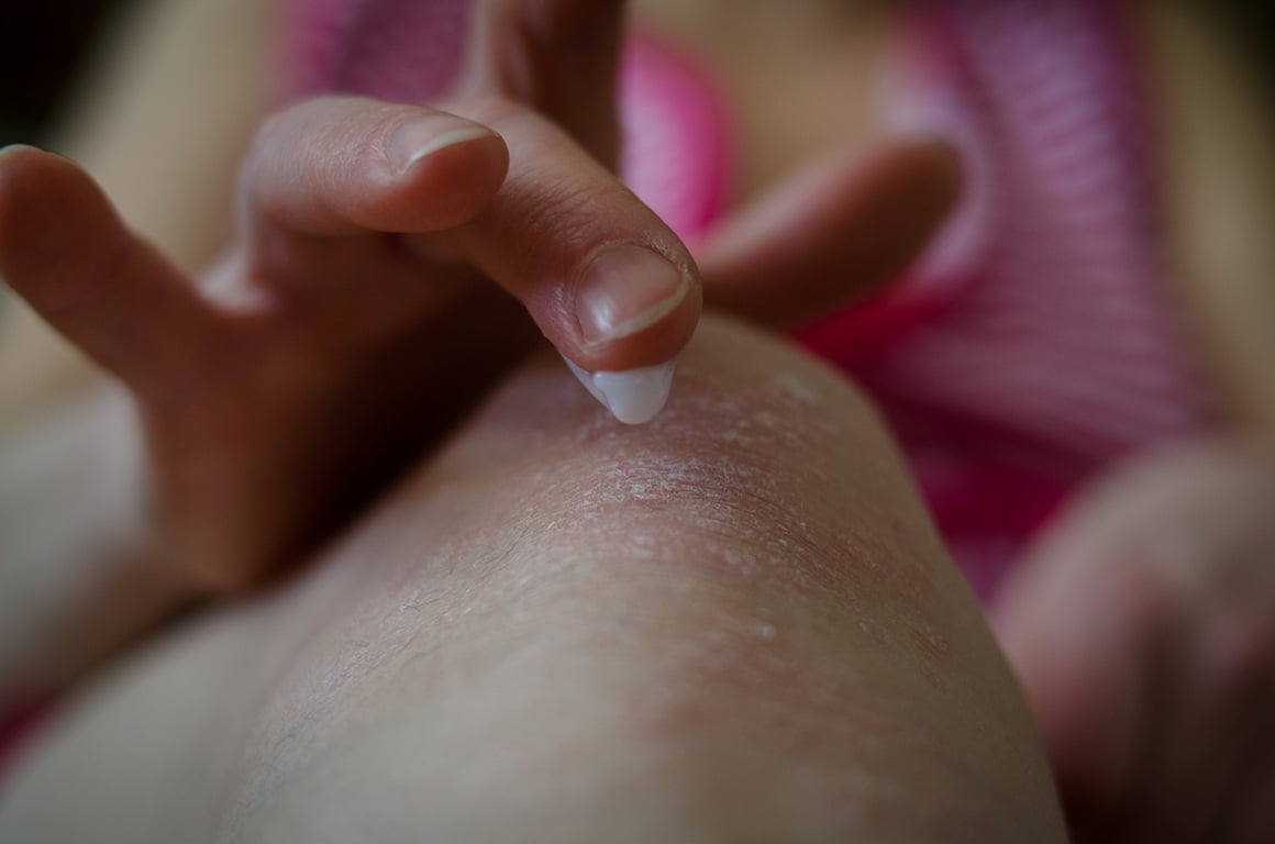 Liječenje psorijaze najčešće uključuje kombinaciju medicinske terapije i promjena životnih navika