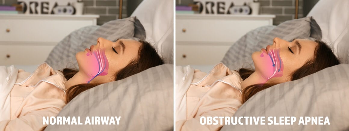 Opstruktivna apneja u snu najčešći je oblik ovog poremećaja