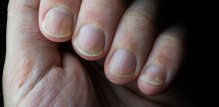 Psorijaza ne zahvaća samo kožu, već i nokte