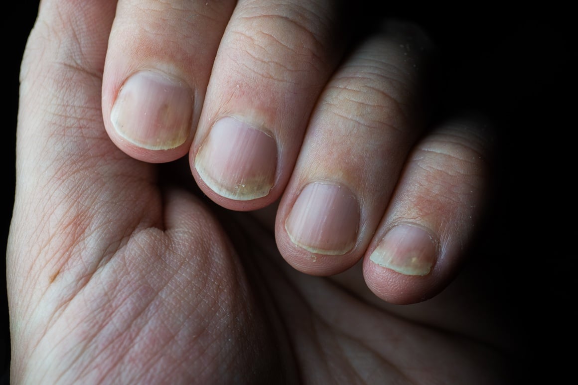 Psorijaza ne zahvaća samo kožu, već i nokte