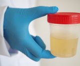 jednostavan test urina mogao pomoći liječnicima da preciznije procijene kojim pacijentima treba dodatna imunoterapija kod raka mokraćnog mjehura