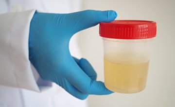jednostavan test urina mogao pomoći liječnicima da preciznije procijene kojim pacijentima treba dodatna imunoterapija kod raka mokraćnog mjehura