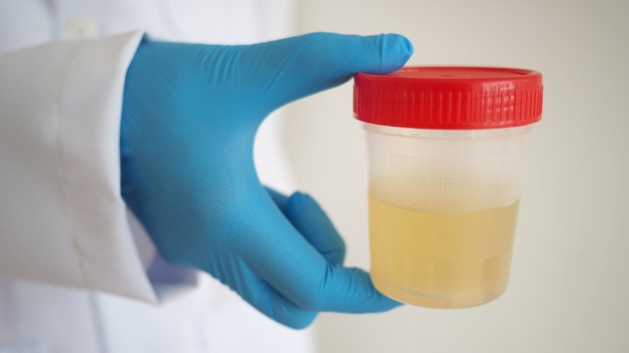 jednostavan test urina mogao pomoći liječnicima da preciznije procijene kojim pacijentima treba dodatna imunoterapija kod raka mokraćnog mjehura